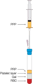 Remove a portion of PPP to achieve higher
platelet concentration (optional)