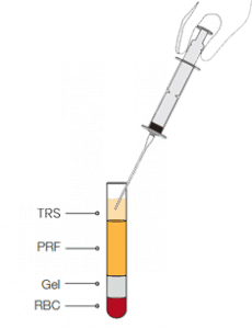 Insert a syringe to collect the TRS serum